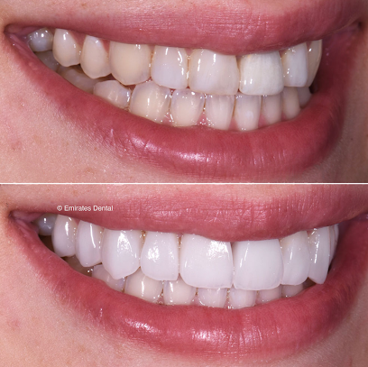 Emirates Dental - Cosmetic Dentistry and Clear Aligners in Dubai image